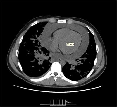 Case Report: Recurrent pericardial tamponade in a child with COVID-19